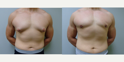 Gynecomastia Surgery before and after photo