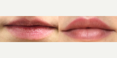 Lip Fillers before and after photo