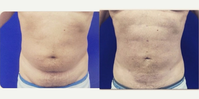 Liposuction before and after photo