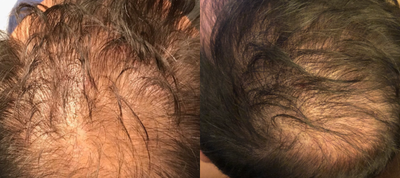 PRP for Hair Loss before and after photo