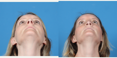 Rhinoplasty before and after photo
