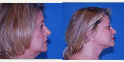Facelift before and after photo