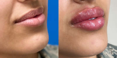 Lip Fillers before and after photo