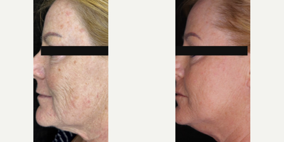 Clear and Brilliant before and after photo