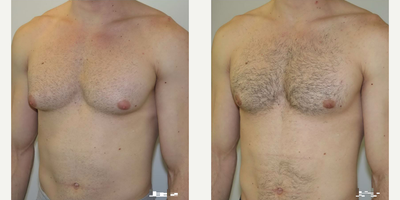 Gynecomastia Surgery before and after photo