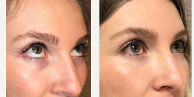 Restylane before and after photo