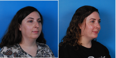 Rhinoplasty before and after photo