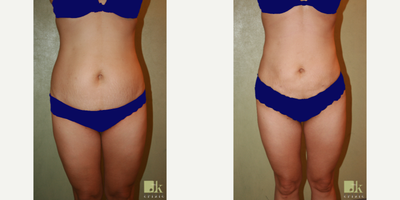 Smart Lipo before and after photo
