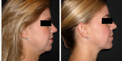 Chin Liposuction before and after photo