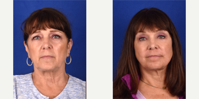 Facelift before and after photo