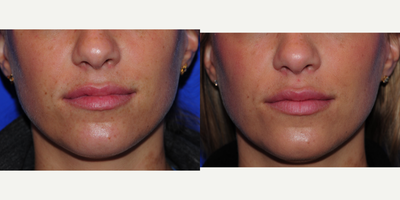 Lip Fillers before and after photo