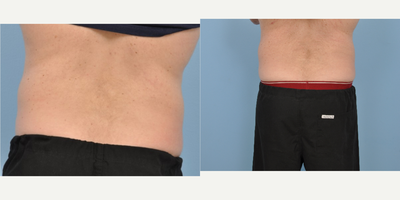 CoolSculpting before and after photo
