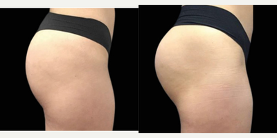 Emsculpt before and after photo