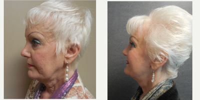 Facelift before and after photo