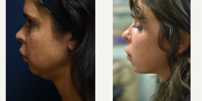 Kybella before and after photo