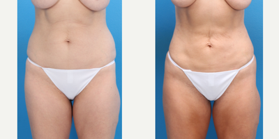 Renuvion before and after photo
