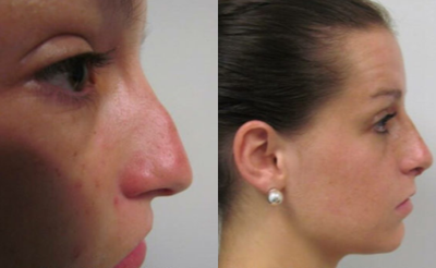 Rhinoplasty before and after photo