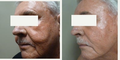 Thread Lift before and after photo