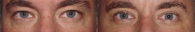 Eyelid Surgery before and after photo