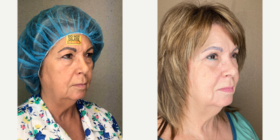 Eyelid Surgery before and after photo