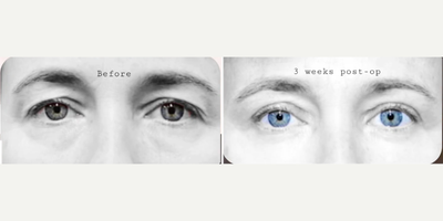 Eyelid Surgery before and after photo