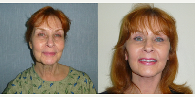 Facelift before and after photo