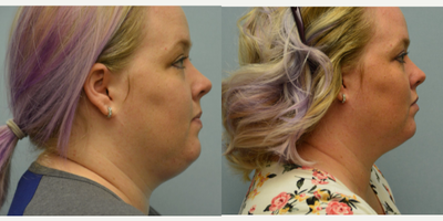 Kybella before and after photo