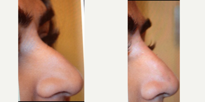 Nonsurgical Nose Job before and after photo