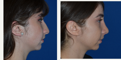 Septoplasty before and after photo