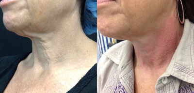 Skin Tightening before and after photo