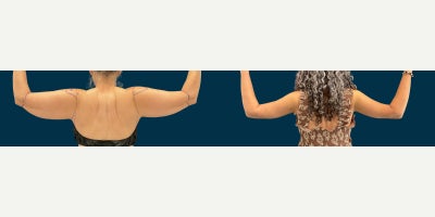 Arm Lift before and after photo