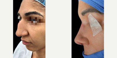 Rhinoplasty before and after photo