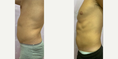 BodyTite before and after photo
