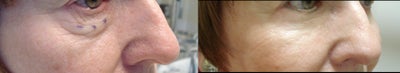 Cheek Lift before and after photo