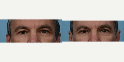 Eyelid Surgery before and after photo
