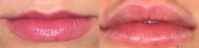 Lip Fillers before and after photo