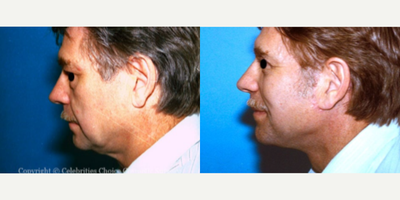 Neck Lift before and after photo