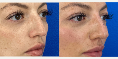 Nonsurgical Nose Job before and after photo