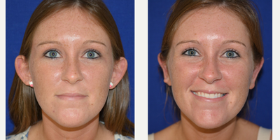 Ear Surgery before and after photo