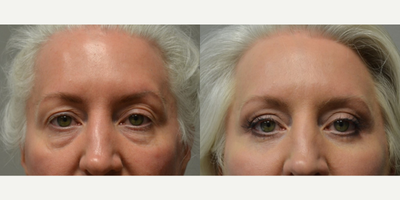 Eyelid Surgery before and after photo