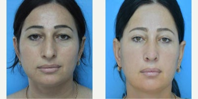 Eyelid Surgery before and after photo