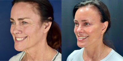 Eyelid Surgery before and after photo