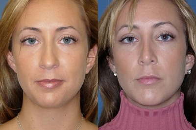 Rhinoplasty before and after photo