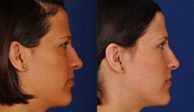 Rhinoplasty before and after photo