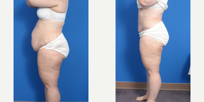 Tummy Tuck before and after photo