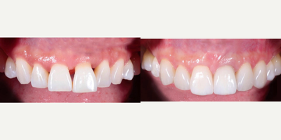 Dental Implants before and after photo