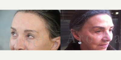 Eyebrow Transplant before and after photo