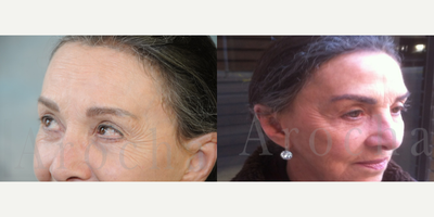 Eyebrow Transplant before and after photo