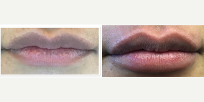 Juvederm before and after photo