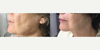 Kybella before and after photo